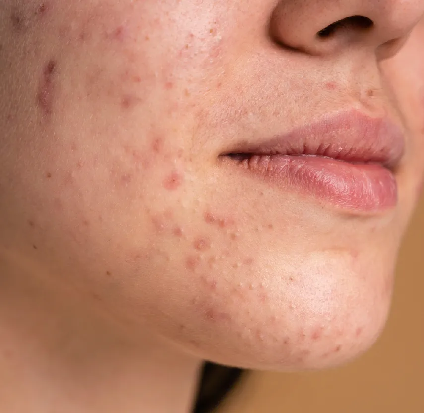 Professionelle Aknebehandlung in München bei Dermatologie im Schlosspalais