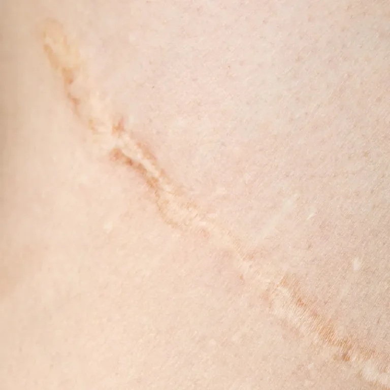 Narbenbehandlung München Blogbild
