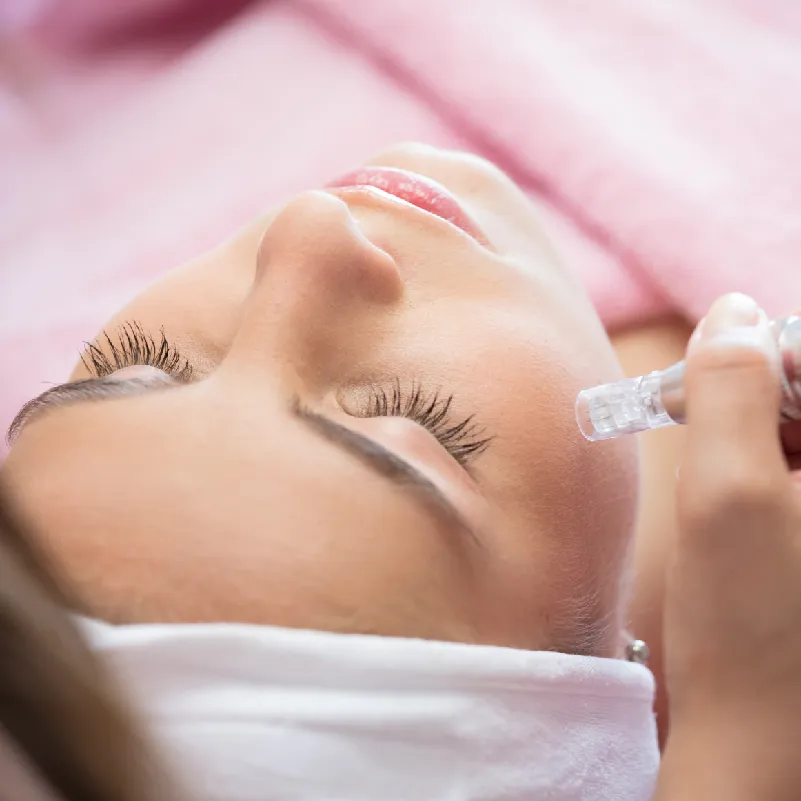 Microneedling in München bei Dermatologie im Schlosspalais