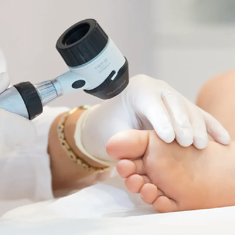 Warzen entfernen in München bei Dermatologie im Schlosspalais